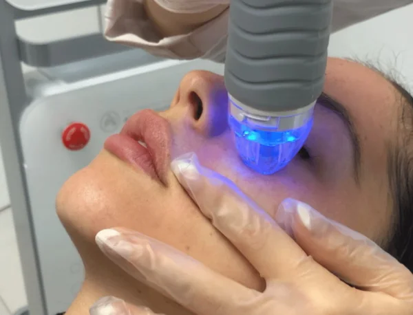 RF trị sẹo lõm