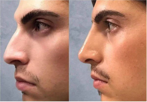 tiêm filler nâng mũi